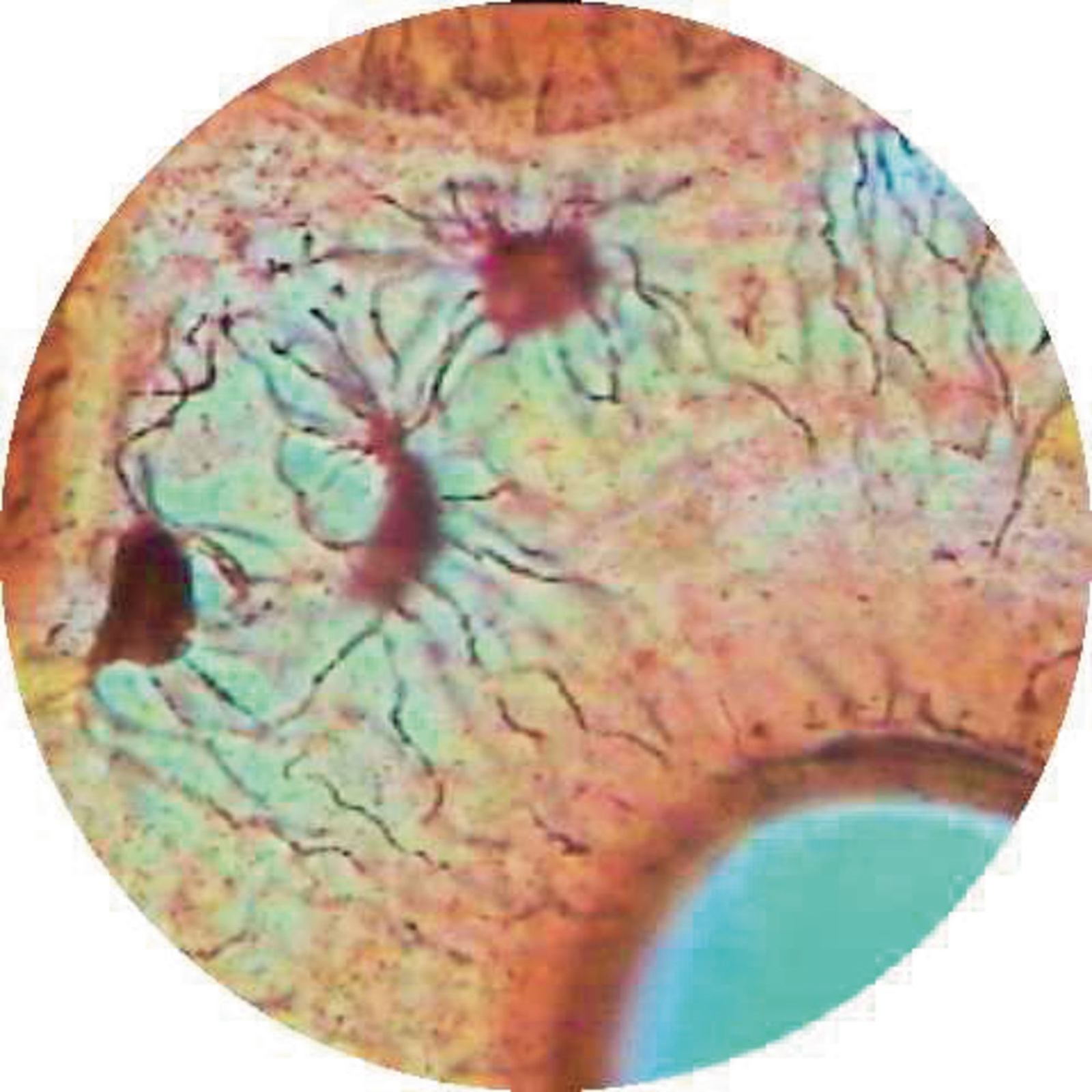 Pseudostratified Ciliated Columnar Epith