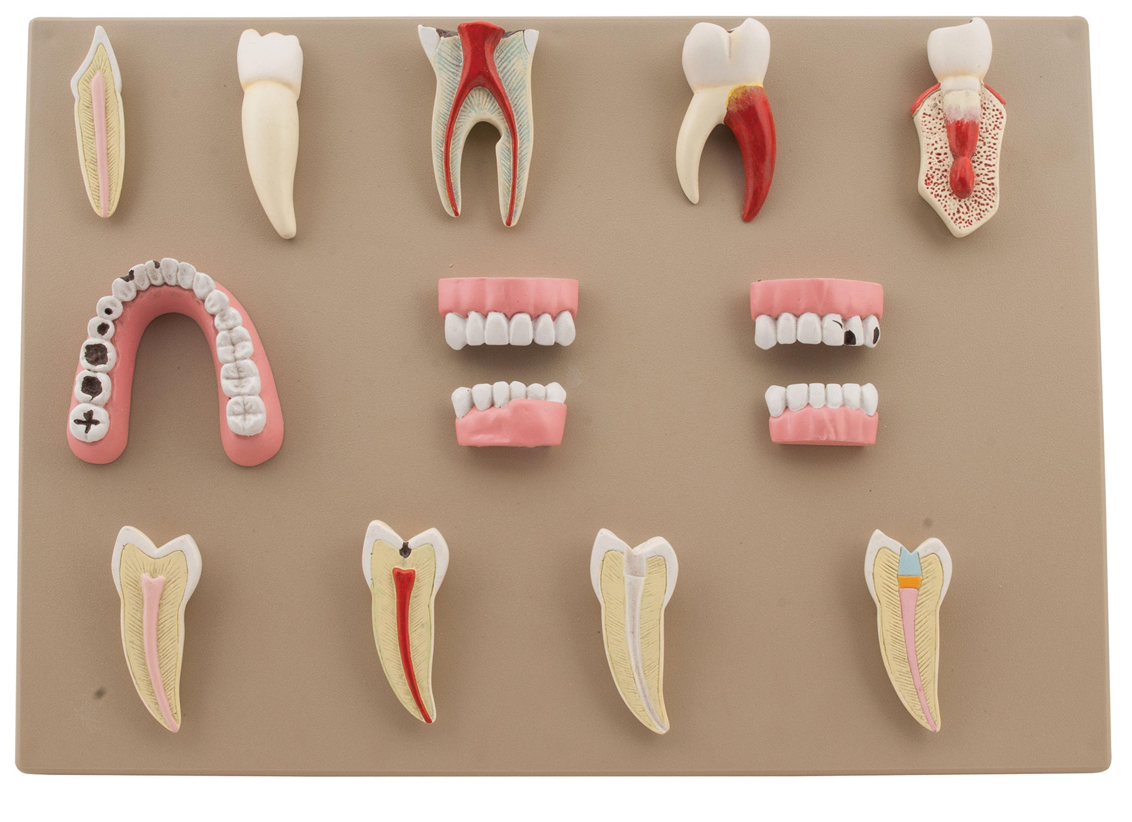 Dental Disease: Mounted Model